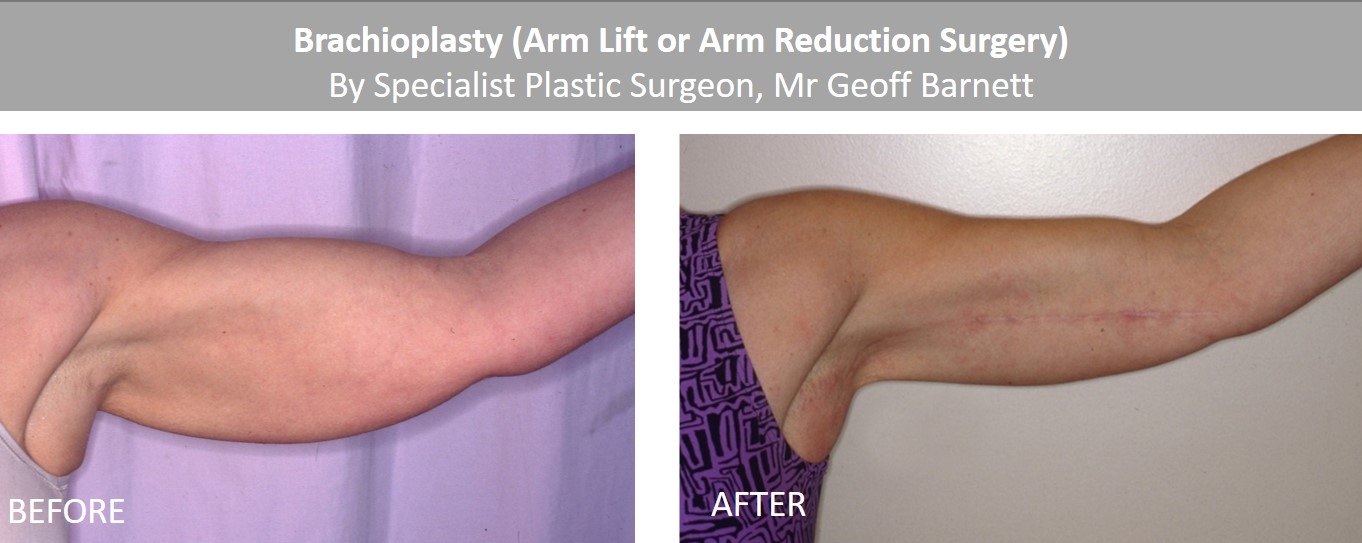 brachioplasty-arm-lift-surgery-upper-arm-reduction